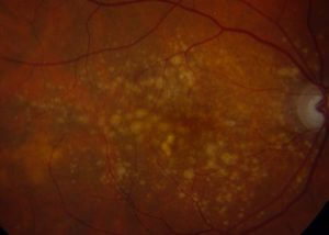 An image depicting Age-Related Macular Degeneration