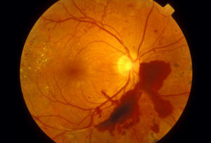 A photo depicting Diabetic Retinopath