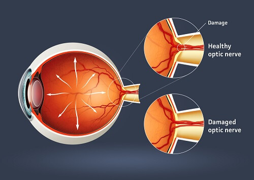 Medical illustration of how glaucoma damages the optic nerve