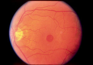 A picture depicting a Macular Hole