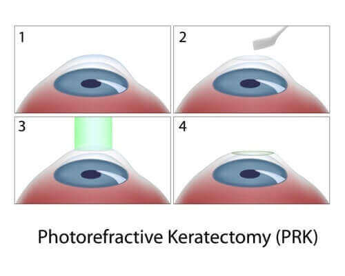 Medical illustration of PRK procedure