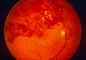 A picture depicting Retinal Venous Occlusion