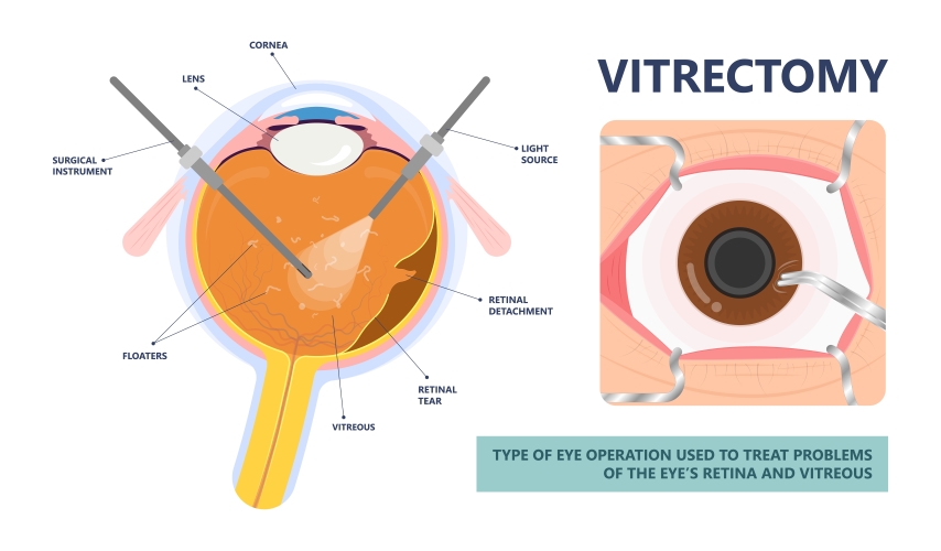 Vitrectomy Altoona | Eye Surgery Brookville, PA | Laurel Eye Clinic DuBois