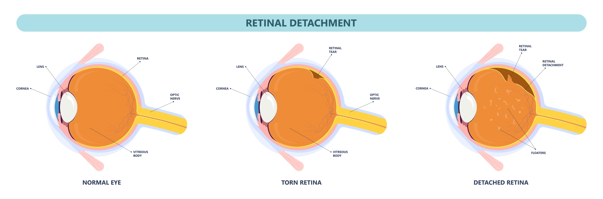 What Is a Detached Retina? - Outlook Eyecare